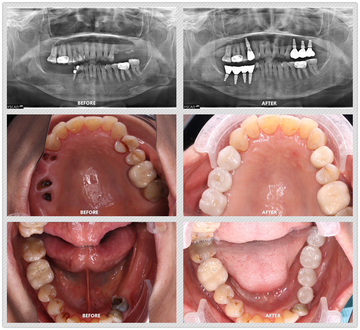 Dental Implant Case