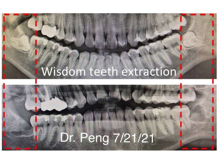 Wisdom Teeth extraction