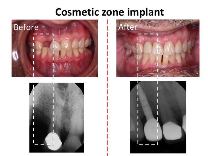Cosmetic Zone Implant