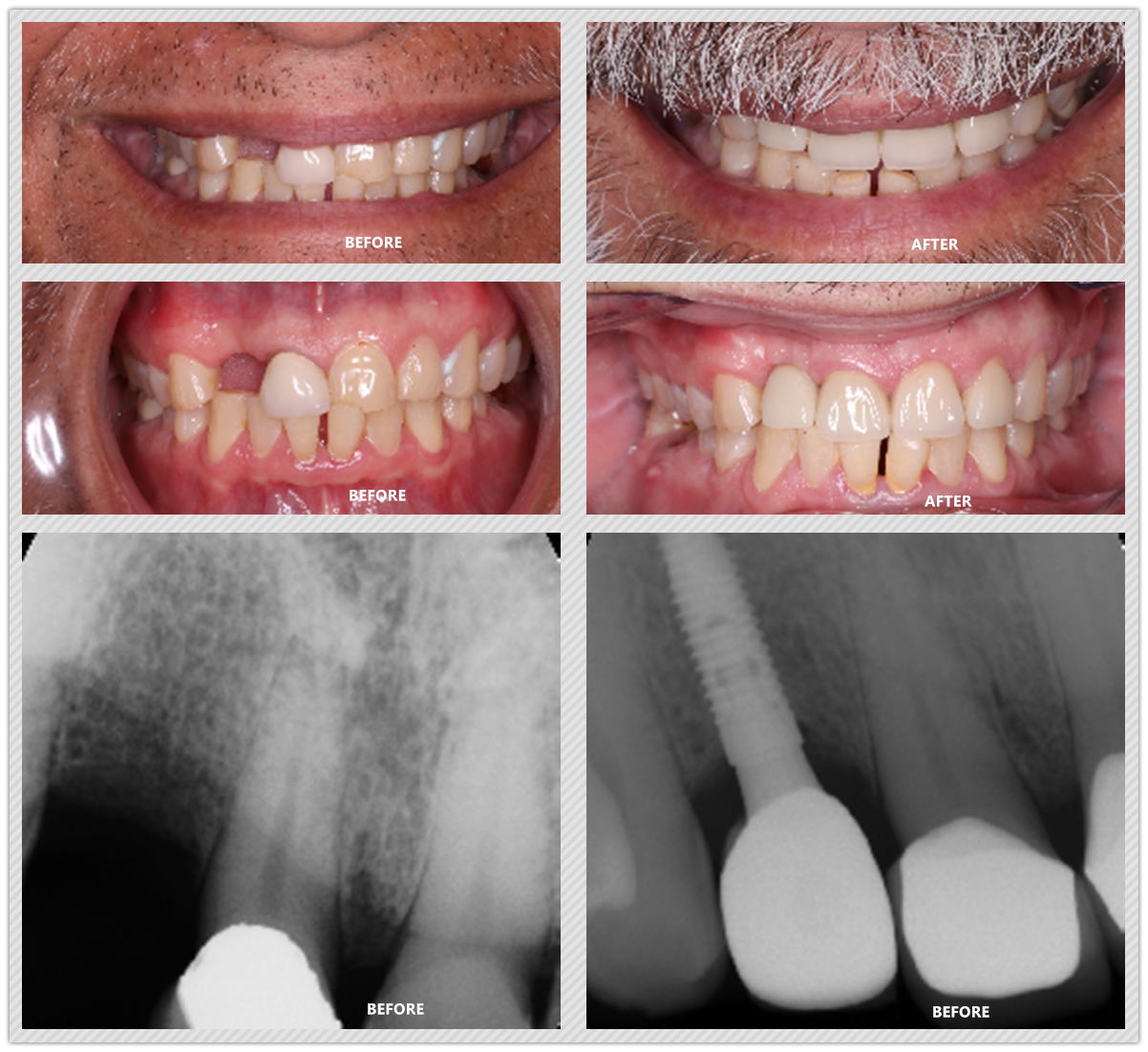 Dental Implant Case