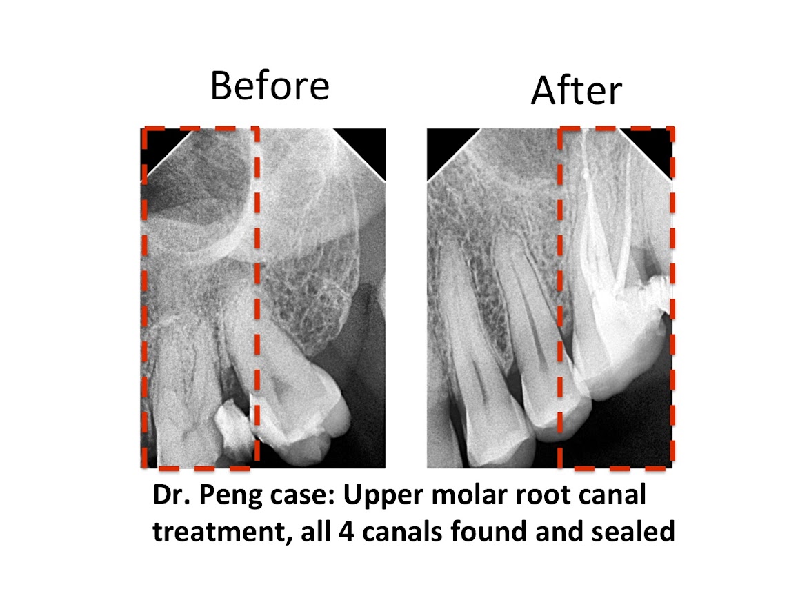 Upper molar root canal treatment, all 4 canals found and sealed