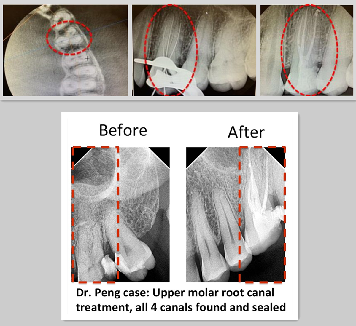 Root Canal Therapy