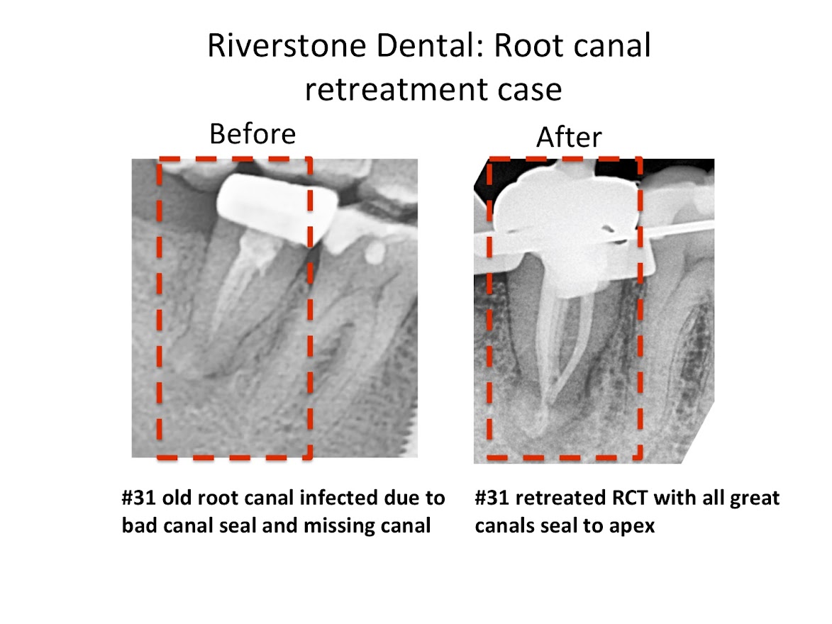 Root canal retreatment case