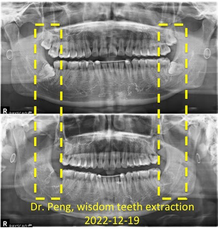 Wisdom Teeth Extraction