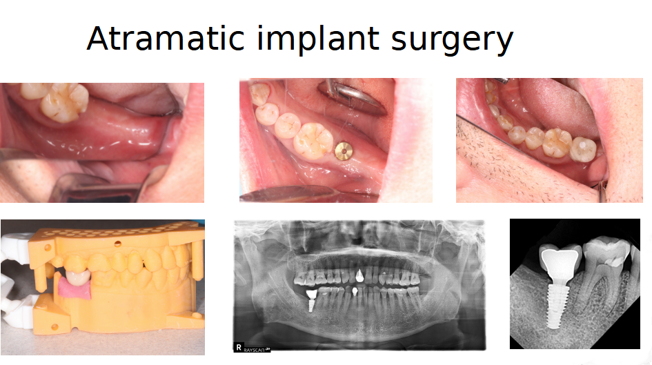 Atramatic Implant Surgery