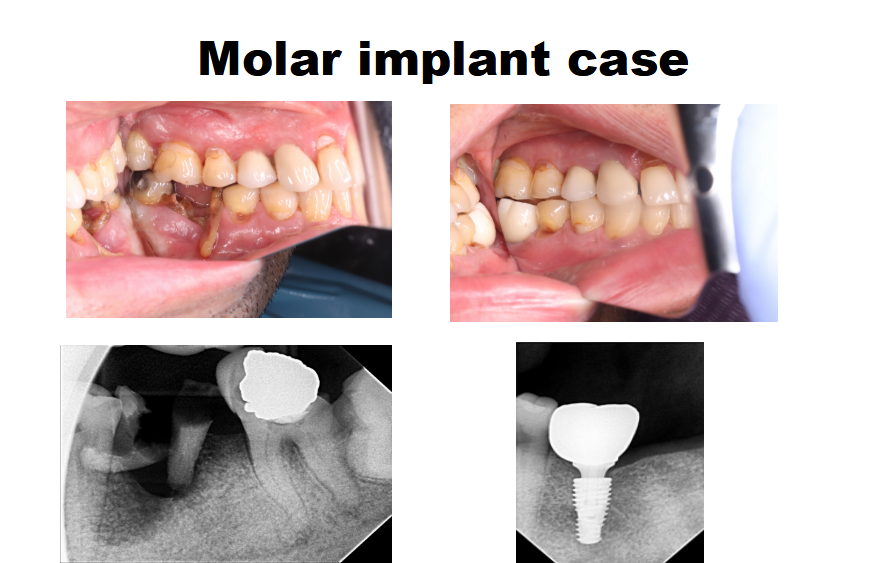 Atramatic Implant Surgery